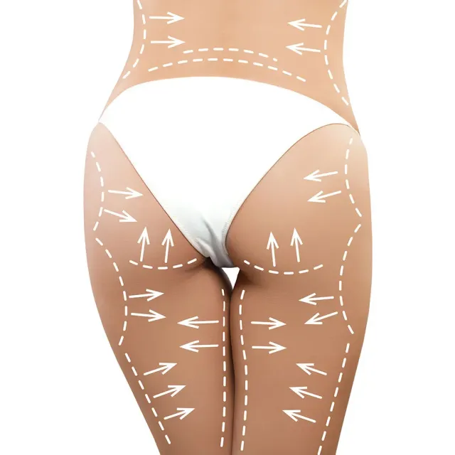 Lipoaspiration