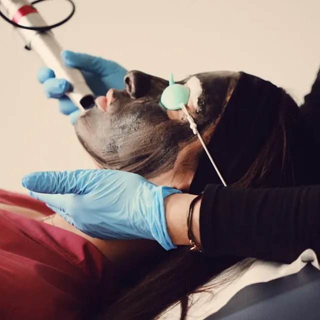 Carbon Peel ou Hollywood Peel