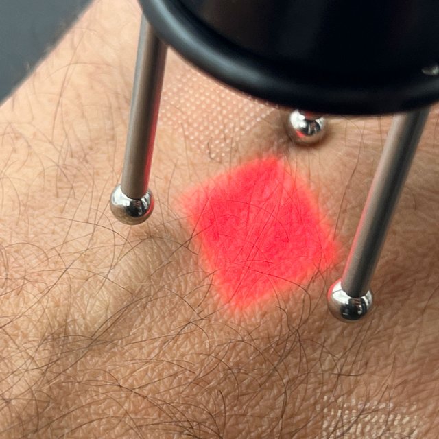Peeling profond laser Fraxel