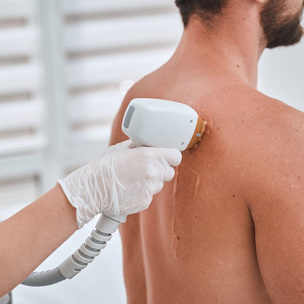 Epilation Laser Dos à Béziers | Réduction Pilosité Homme