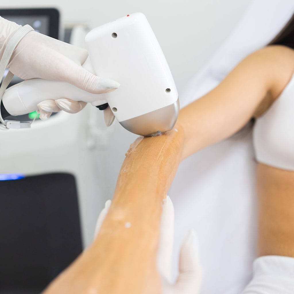 Epilation laser bras à Béziers